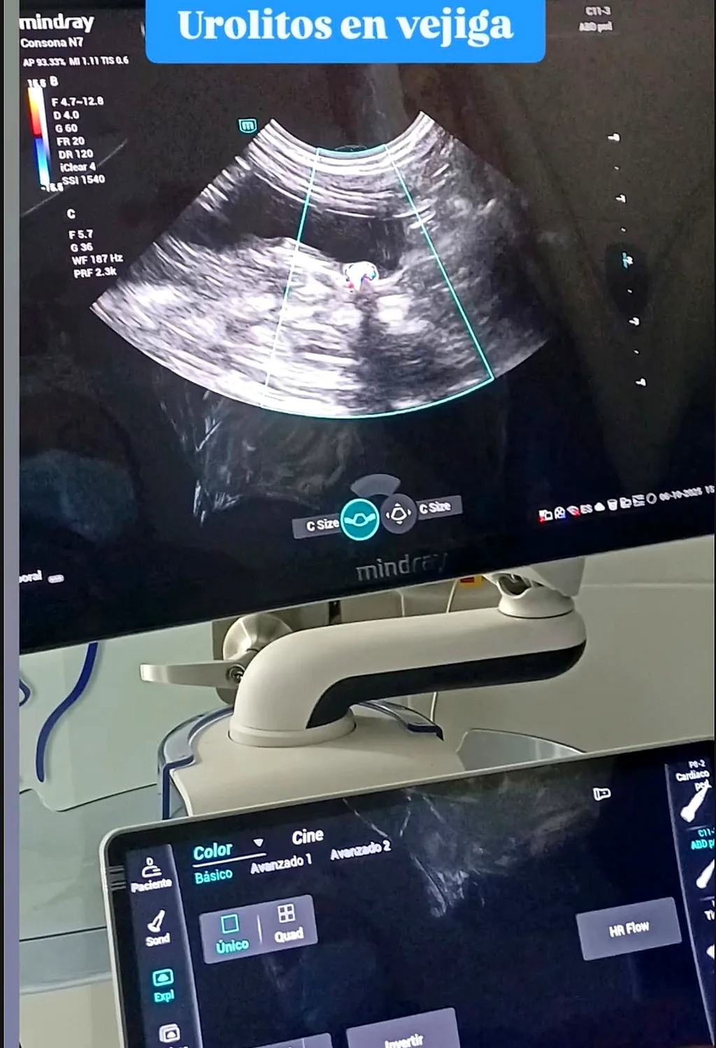 Pantalla del ecógrafo con urolitos en la vejiga